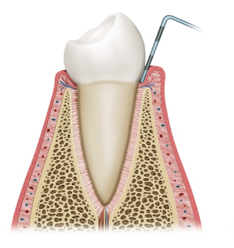 parodontitis-behandlung